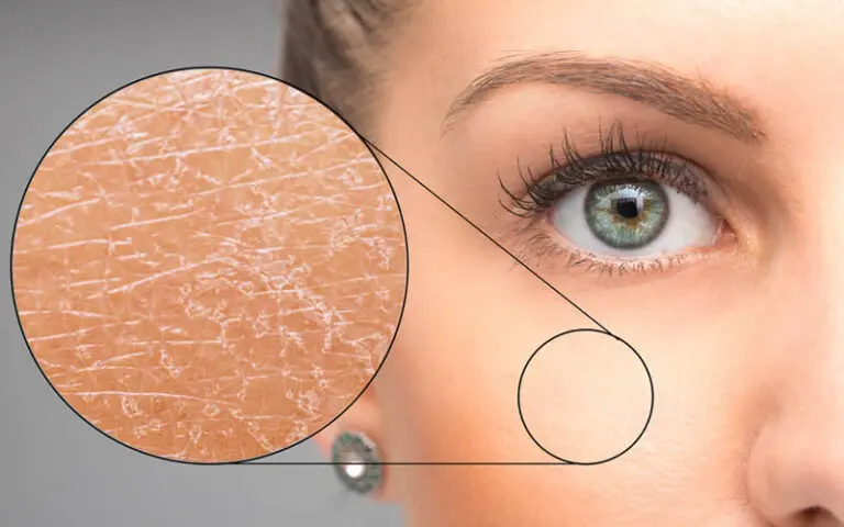 冬はお肌がなぜ乾燥しやすくなる？